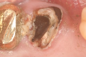 A tooth stump assessed for a root filling