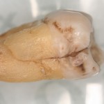 Following a brief investigation the failed tooth was extracted