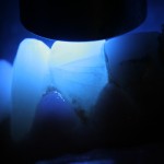 Enamel fracture lines highlighted using a curing light