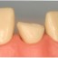 composites-amalgams
